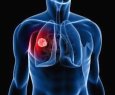 Oncologistas encontram nova tcnica contra cncer de pulmo. - Imunoterapia
